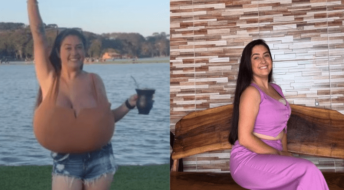 JOVEM DO PARANÁ RETIRA 10 KG DE MAMA APÓS DIAGNÓSTICO DE DOENÇA RARA